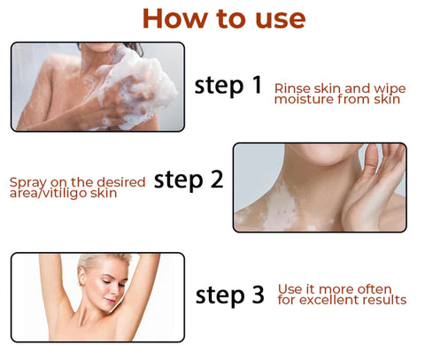 IMAGS™ Spraeadh faochadh Vitiligo