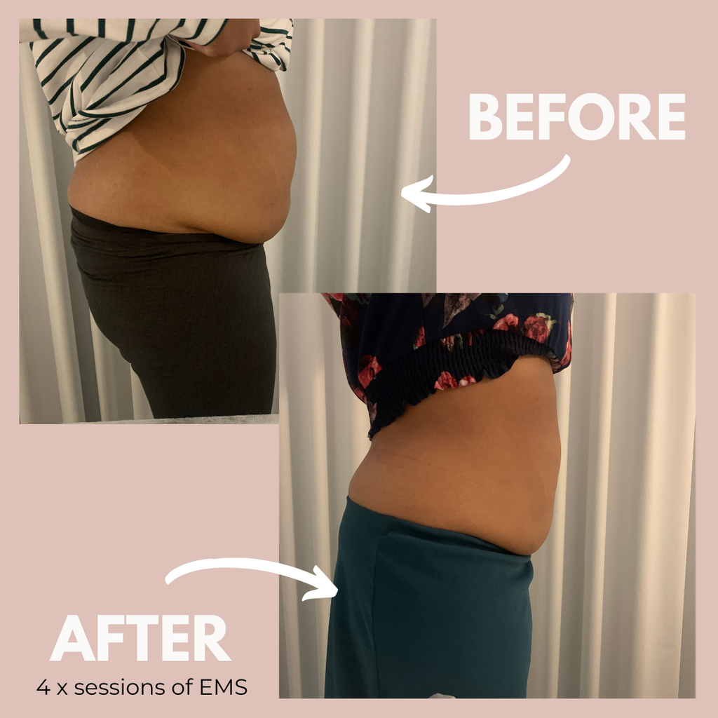 EMS Results - Fat reduction Melbourne