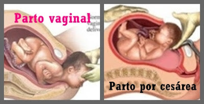 Parto vaginal o cesárea