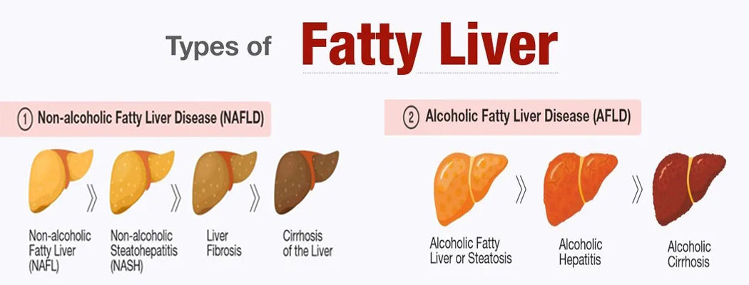 fatty liver type