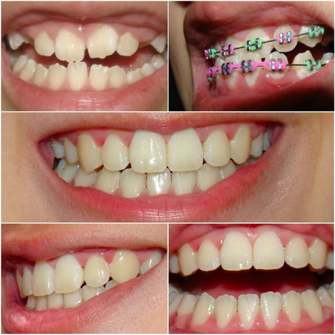 Collage of images showing different stages of dental braces treatment, demonstrating improvement in teeth alignment.
