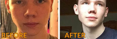 Before and After Image of a 1 year mewing transformation, highlighting visible facial changes and increase facial attractiveness.