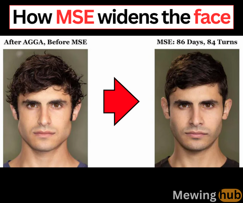 Before and after images of a man's face showing the widening effects of MSE on facial structure after 86 days and 84 turns.