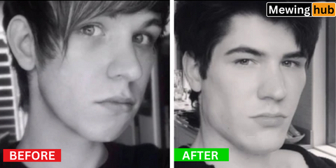 Before and after images showing how mewing has shortened the face and improved jawline definition.