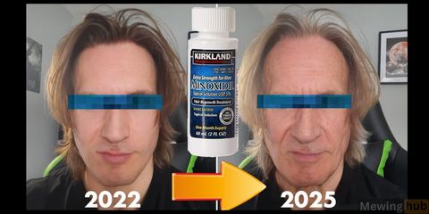 Comparison image showing potential skin drying effects of minoxidil over three years.