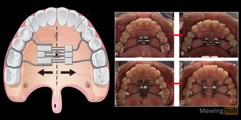 Illustrative comparison of a palatal expander device in use. On the left, a detailed diagram shows the upper view of a mouth with a palatal expander fitted across the upper teeth, indicating the direction of expansion.