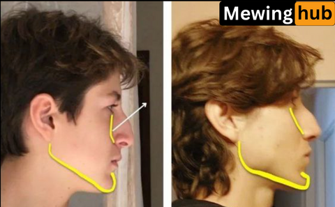 Profile transformation demonstrating how mewing can shorten the face by promoting maxillary up-swing.