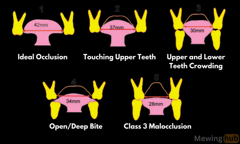 Diagram showing different occlusions including ideal occlusion, touching upper teeth, crowding, open bite, and class 3 malocclusion
