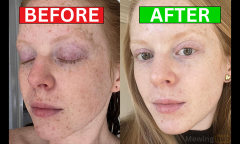 Vitamin C Improved this patients dark spot nearly completely getting rid of them while using a Vitamin C serum.