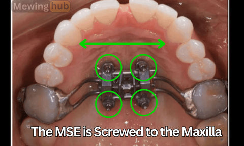 An informative image showing the palate of a candidate with an MSE, showing how the device is screwed into the maxilla.