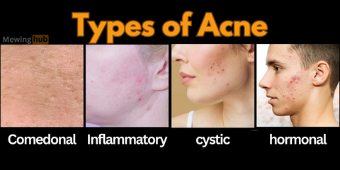 Visual guide to different types of acne including comedonal, inflammatory, cystic, and hormonal acne, displayed on various skin types.