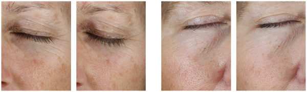 skinbetter science eye max before and after