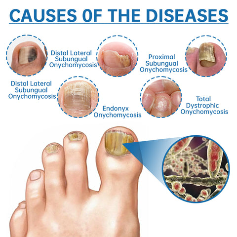 Furzero™ Highly Effective Onychomycosis Machine laser device – glitzora ...