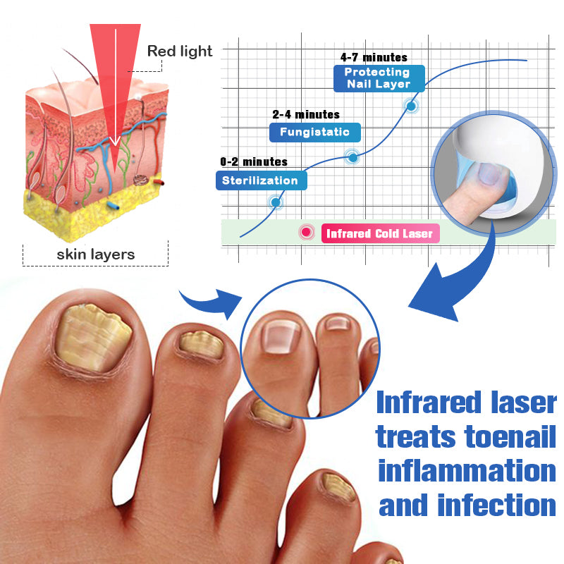 LLLT Cold Laser Therapy Device Soft Laser Therapy Device For Finger Nails  Fungus Treatment Toe Nails Fungus Removal - AliExpress