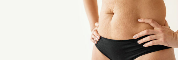 All About Stretch Marks: Answers to Your Questions