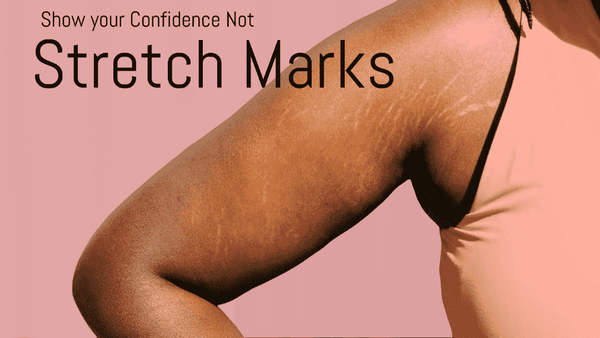 stretch marks