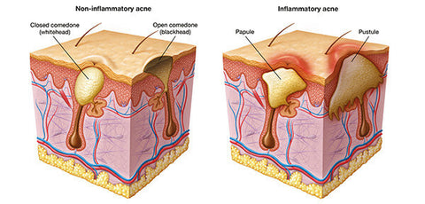 Inflammatory and Non-inflammatory acne (1)