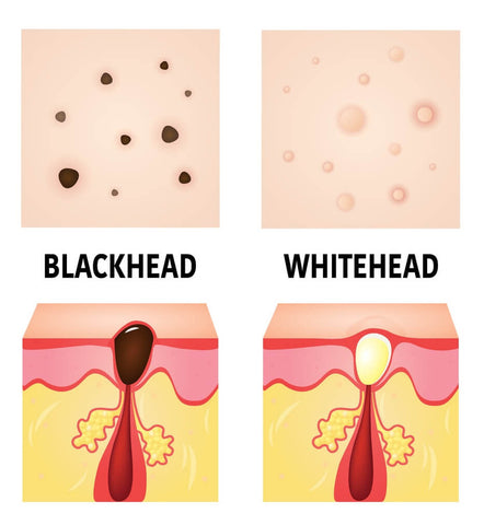 blackhead