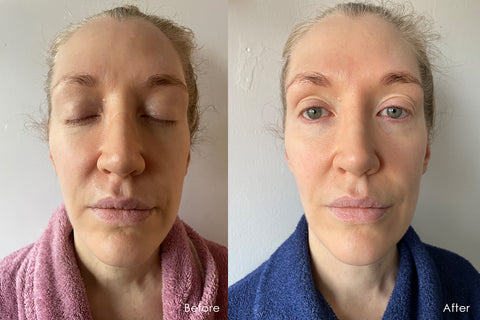 Before and After Effects of RED LED+ Anti-Aging Therapy