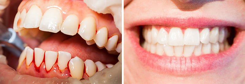 SmileMate™ Teeth Whitening Repair Regrowth Dental Gel