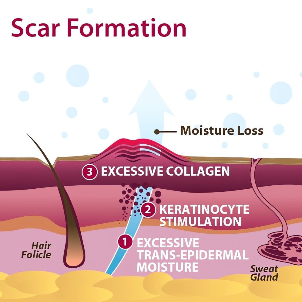 ScarRemove™ Scar and Stretch Mark Refining Spray