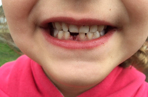 Image of a child's mouth with a front tooth missing