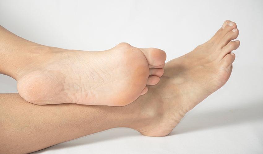 The sole of a foot that is showing a prominent bunion deformity