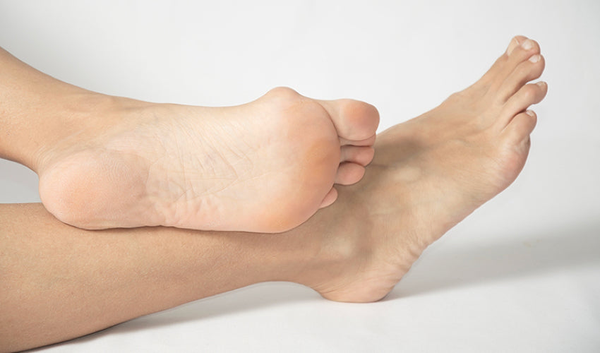 How to Prevent Bunions & Hammertoes
