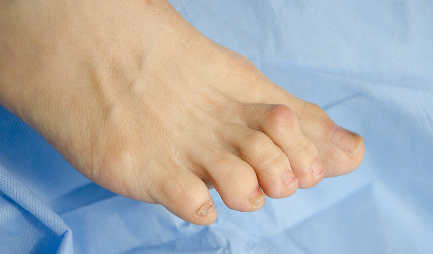 A close up shot of a bare foot showing multiple hammertoes