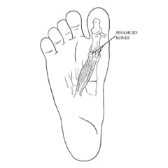 A cartoon graphic depicting the sole of the foot and the location of the sesamoid bones