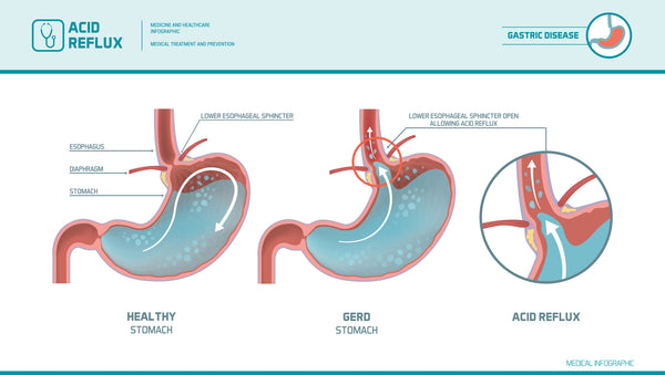 how acid causes reflux