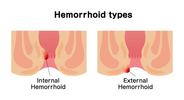 internal or external hemorrhoids
