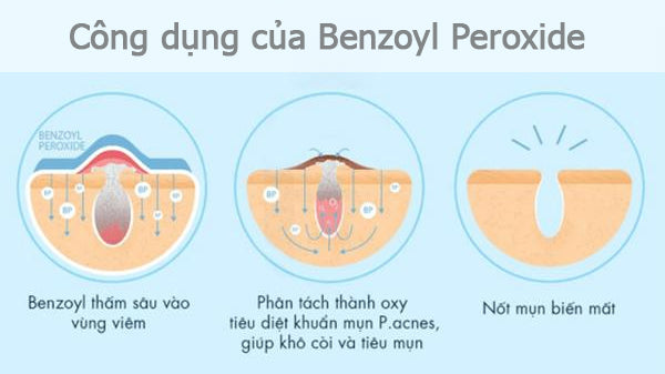 công dụng của Benzoyl Peroxide là gì, Benzoyl Peroxide có tác dụng gì