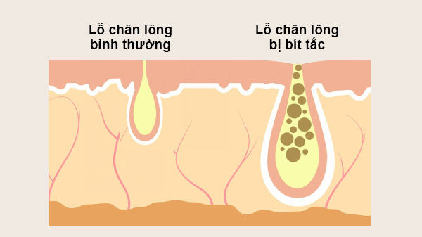 nguyên nhân gây bít tắc lỗ chân lông ở mặt, nguyên nhân làm bít tắc lỗ chân lông ở mặt