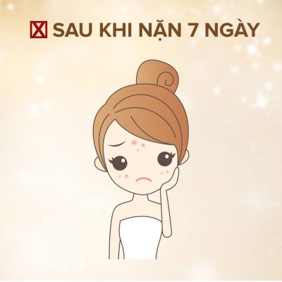 chăm sóc da mặt sau khi nặn mụn, sau khi nặn mụn bao lâu thì skincare
