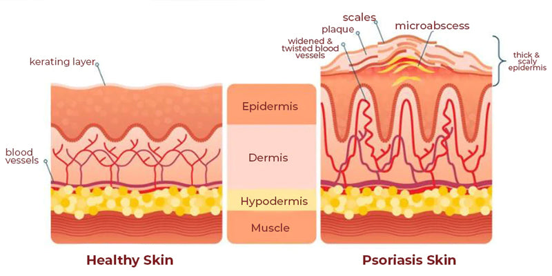 Suupillid™ Herbal Psoriasis Relief Spray
