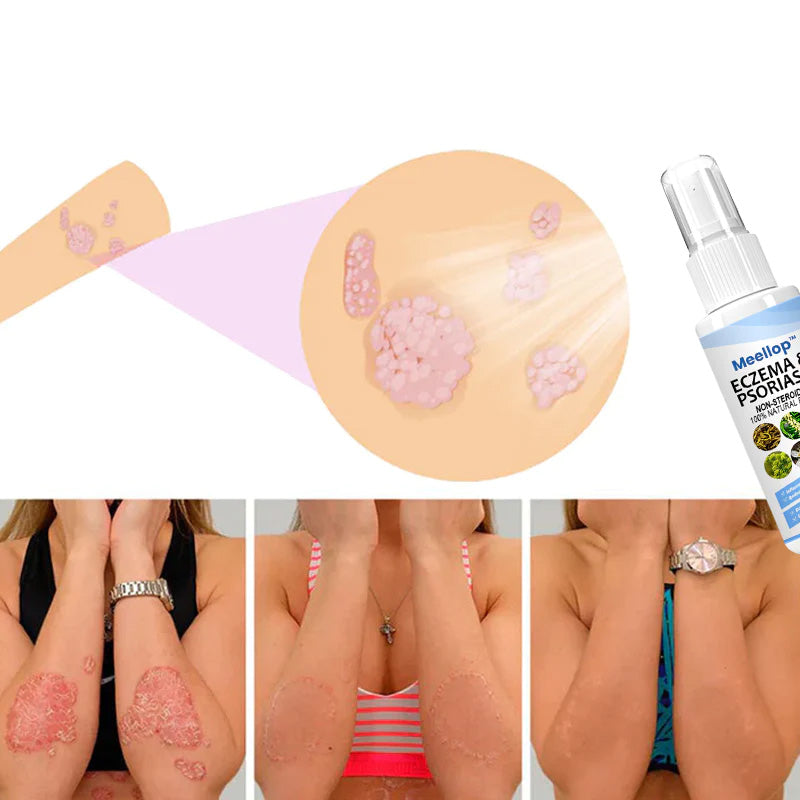 Suupillid™ Herbal Psoriasis Relief Spray 