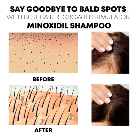 ATTDX HairReborn Minoxidil Shampoo