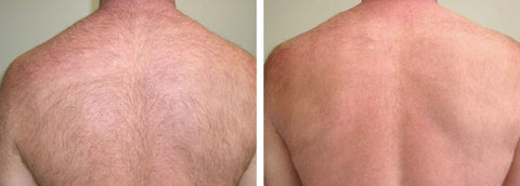 Laser Back Hair Removal  Before  After