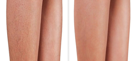 Laser Hair Removal Legs Before and After