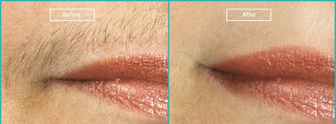 Upper Lip Laser Hair Removal Before and After