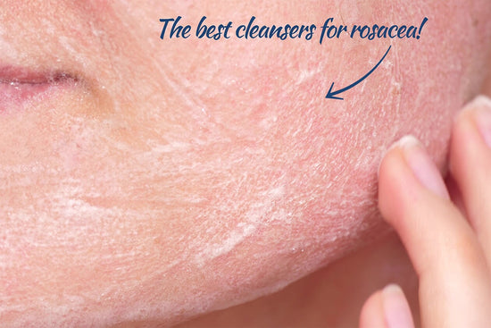 Best Rosacea Cleansers