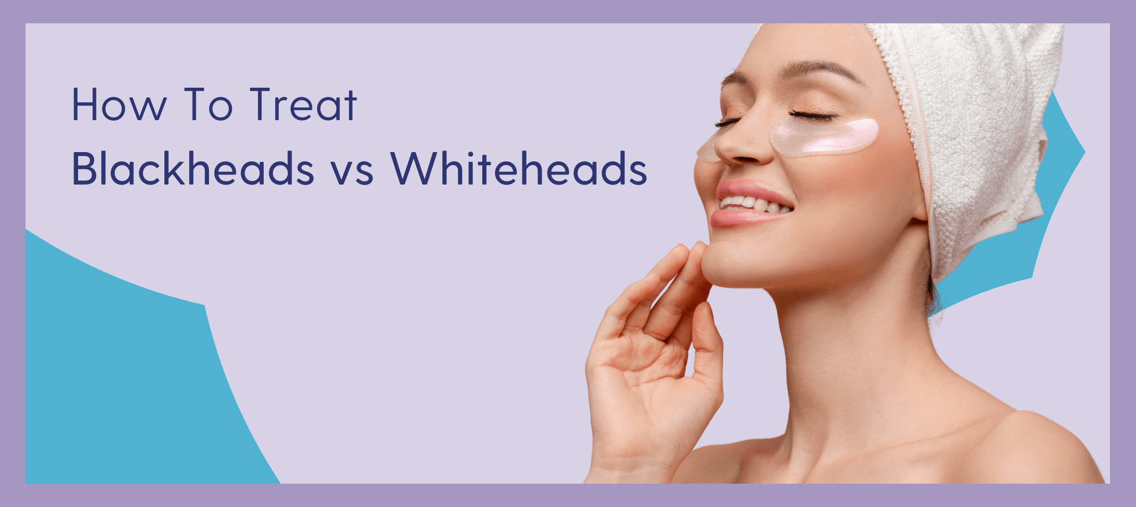 how to treat blackheads vs whiteheads