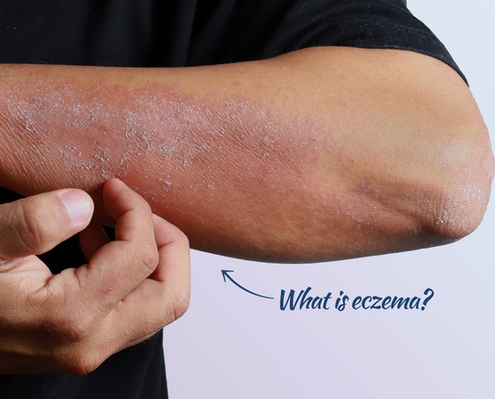 What is eczema? Over an image of an elbow with eczema.