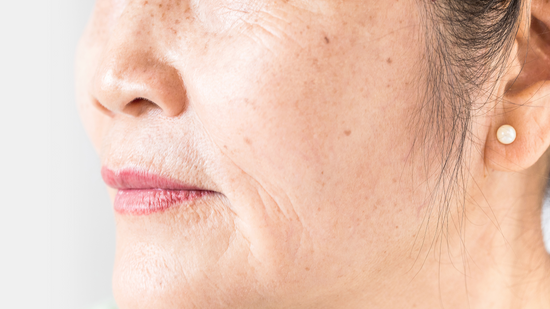 aging skin