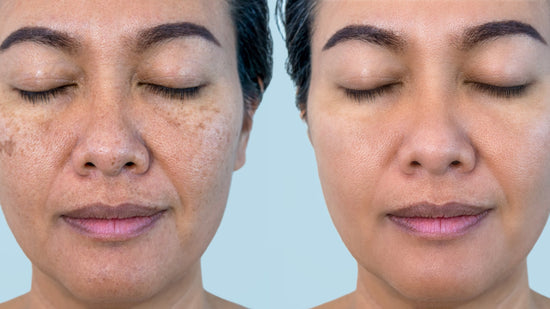 What is Melasma?