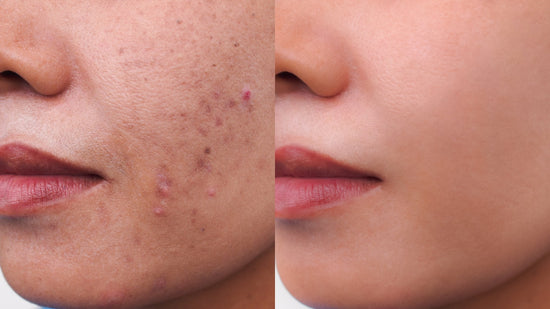 How To Treat Post-Inflammatory Hyperpigmentation PIH Skin?