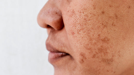 Inflammation Causes Hyperpigmentation