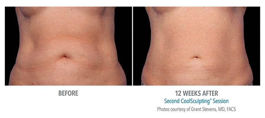 CoolSculpting