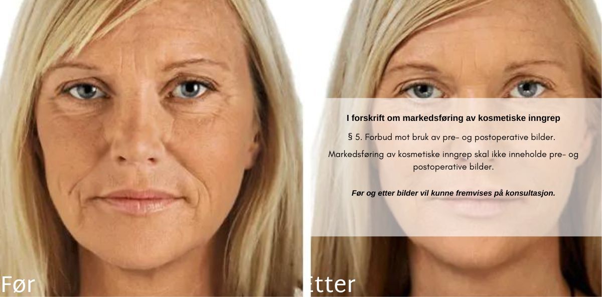 før og etter restylane skinbooster